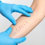 Allergy Testing for Adults: Skin vs. Blood Tests